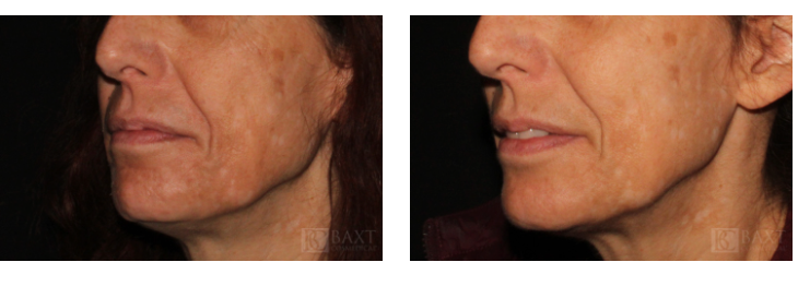 See More Before/After Chemical Peel Patient 504 See More Before/After Chemical Peel Patient 504