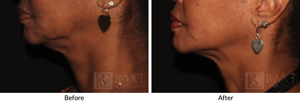 Before and After Ultherapy PRIME Results by Dr. Baxt