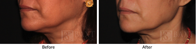Before and After Ultherapy PRIME Results by Dr. Baxt