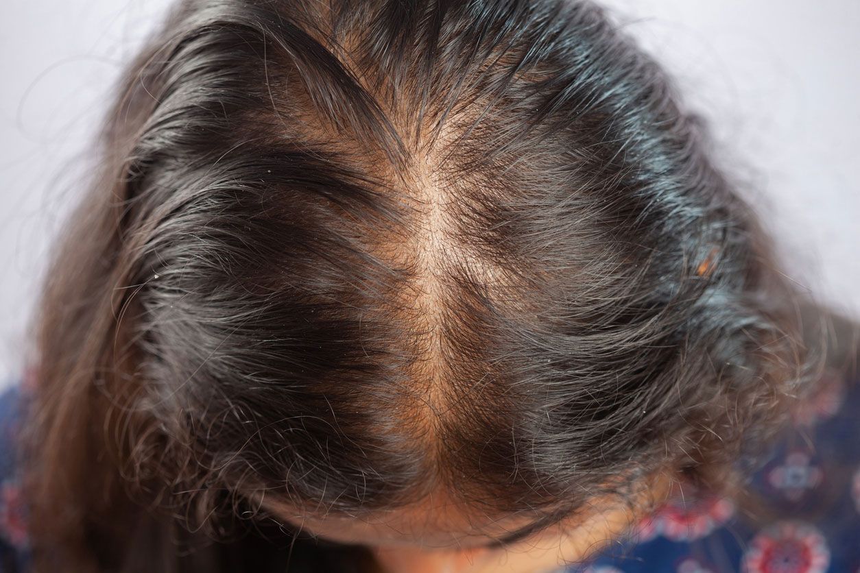 August is National Hair Loss Awareness Month