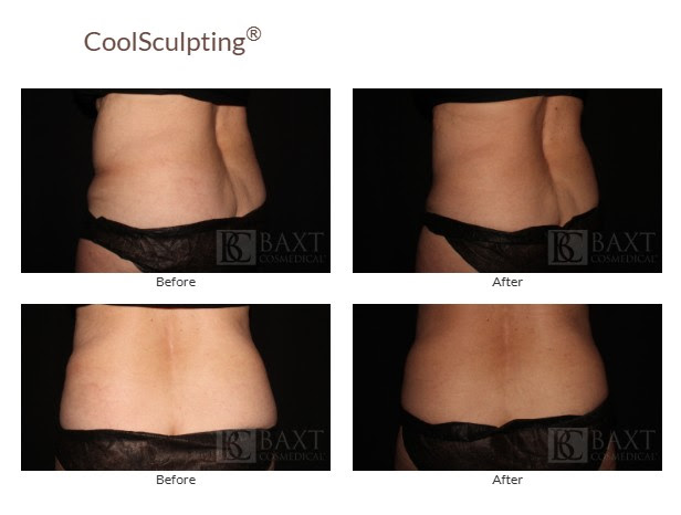CoolSculpting