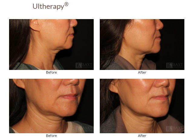 Ultherapy PRIME