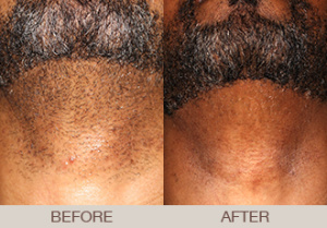 Laser Hair Removal Gallery