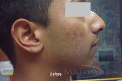 Acne Treatment Before - Paramus, NJ Acne Treatment Before - Paramus, NJ