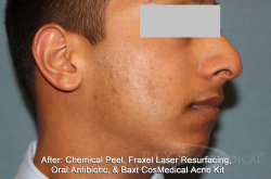 Acne Treatment After - Paramus, NJ Acne Treatment After - Paramus, NJ