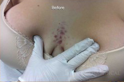 Acne Treatment Before - Paramus, NJ Acne Treatment Before - Paramus, NJ