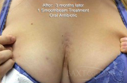 Acne Treatment After - Paramus, NJ Acne Treatment After - Paramus, NJ