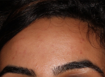 Acne Treatment After - Paramus, NJ Acne Treatment After - Paramus, NJ