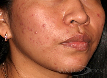 Acne Treatment Before - Paramus, NJ