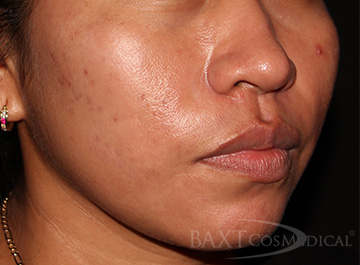 Acne Treatment After - Paramus, NJ