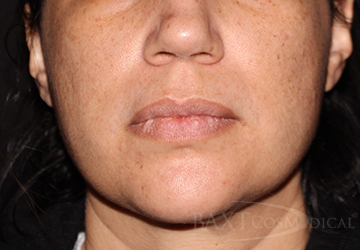 Acne Treatment After - Paramus, NJ Acne Treatment After - Paramus, NJ