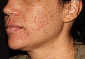 Acne Treatment Before - Paramus, NJ Acne Treatment Before - Paramus, NJ