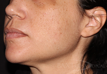 Acne Treatment After - Paramus, NJ Acne Treatment After - Paramus, NJ