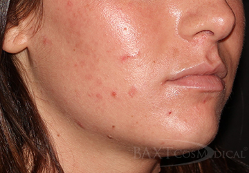Closeup of a patient with acne before treatment