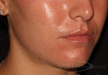 After acne treatment Closeup of a patient with less acne after treatment