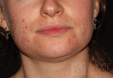 Acne Treatment Before - Paramus, NJ Acne Treatment Before - Paramus, NJ