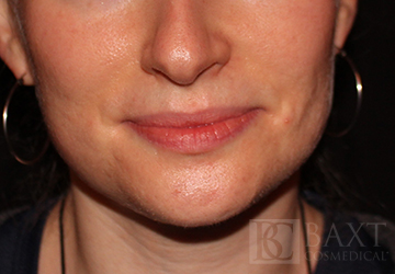 Acne Treatment After - Paramus, NJ Acne Treatment After - Paramus, NJ