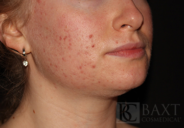 Acne Treatment Before - Paramus, NJ Acne Treatment Before - Paramus, NJ