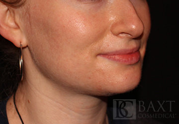 Acne Treatment After - Paramus, NJ Acne Treatment After - Paramus, NJ