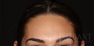 Acne Treatment After - Paramus, NJ Acne Treatment After - Paramus, NJ