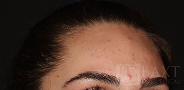 Acne Treatment Before - Paramus, NJ Acne Treatment Before - Paramus, NJ
