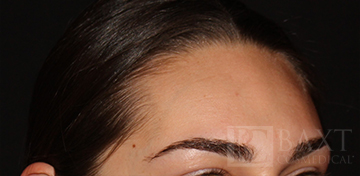 Acne Treatment After - Paramus, NJ Acne Treatment After - Paramus, NJ
