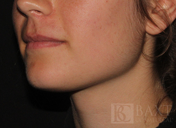 Acne Treatment After - Paramus, NJ Acne Treatment After - Paramus, NJ