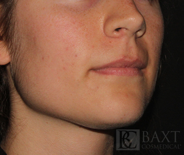 Acne Treatment After - Paramus, NJ Acne Treatment After - Paramus, NJ