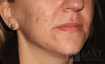 Acne Treatment Before - Paramus, NJ Acne Treatment Before - Paramus, NJ