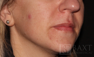 Acne Treatment After - Paramus, NJ Acne Treatment After - Paramus, NJ