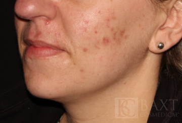 Acne Treatment Before - Paramus, NJ Acne Treatment Before - Paramus, NJ