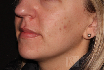 Acne Treatment After - Paramus, NJ Acne Treatment After - Paramus, NJ