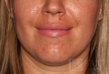 Acne Treatment Before - Paramus, NJ Acne Treatment Before - Paramus, NJ