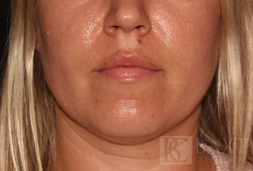 Acne Treatment After - Paramus, NJ Acne Treatment After - Paramus, NJ