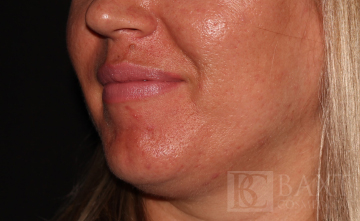 Acne Treatment Before - Paramus, NJ Acne Treatment Before - Paramus, NJ