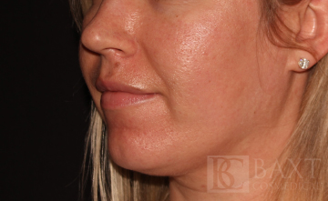 Acne Treatment After - Paramus, NJ Acne Treatment After - Paramus, NJ