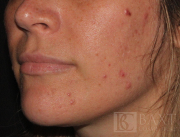 Acne Treatment Before - Paramus, NJ Acne Treatment Before - Paramus, NJ