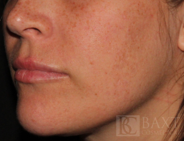 Acne Treatment After - Paramus, NJ Acne Treatment After - Paramus, NJ