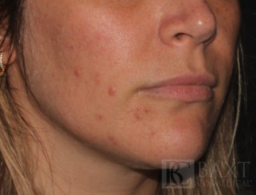 Acne Treatment Before - Paramus, NJ Acne Treatment Before - Paramus, NJ