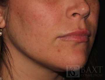 Acne Treatment After - Paramus, NJ Acne Treatment After - Paramus, NJ