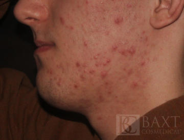 Acne Treatment Before - Paramus, NJ Acne Treatment Before - Paramus, NJ
