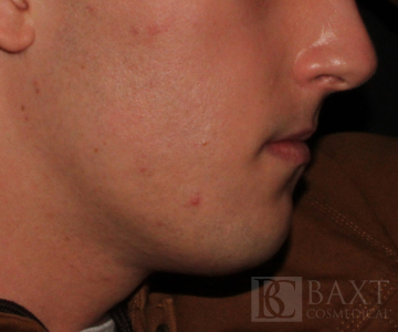 Acne Treatment After - Paramus, NJ Acne Treatment After - Paramus, NJ
