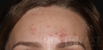 Acne Treatment Before - Paramus, NJ Acne Treatment Before - Paramus, NJ