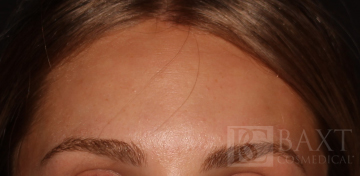 Acne Treatment After - Paramus, NJ Acne Treatment After - Paramus, NJ