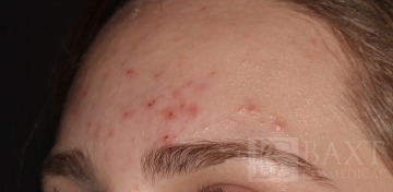 Acne Treatment Before - Paramus, NJ Acne Treatment Before - Paramus, NJ