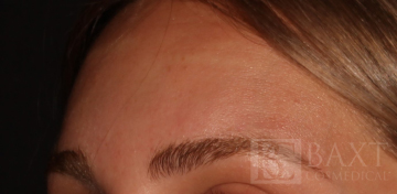 Acne Treatment After - Paramus, NJ Acne Treatment After - Paramus, NJ