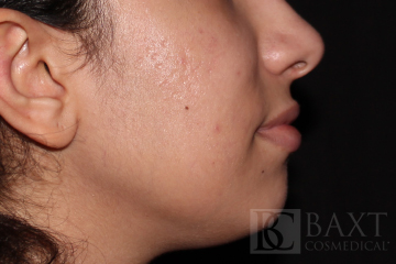 Acne Treatment Before - Paramus, NJ Acne Treatment Before - Paramus, NJ
