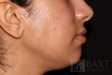 Acne Treatment After - Paramus, NJ Acne Treatment After - Paramus, NJ