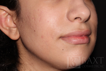 Acne Treatment Before - Paramus, NJ Acne Treatment Before - Paramus, NJ