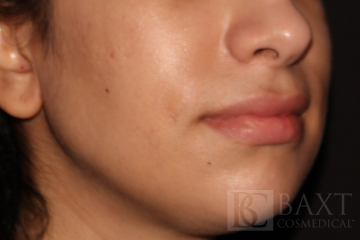 Acne Treatment After - Paramus, NJ Acne Treatment After - Paramus, NJ